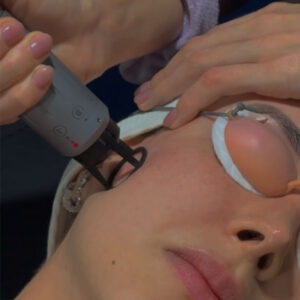 THE CLEARLIFT LÁSER FACIAL