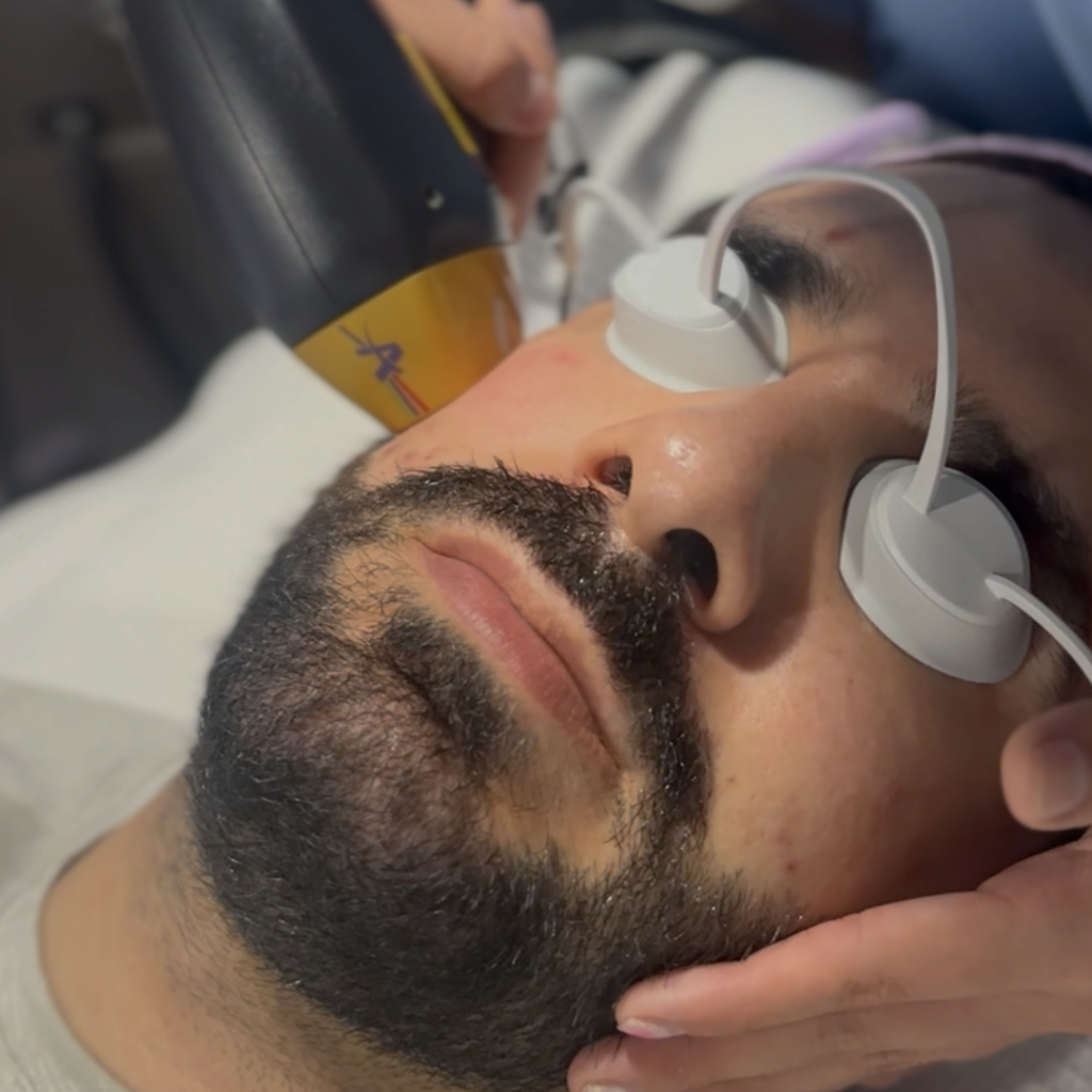 Soprano Ice Depilacion Laser Barba Precio Laser Blacksoprano