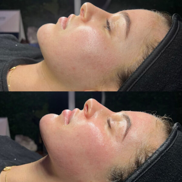 HYDRAFACIAL SIGNATURE + GLACIAL GLIDE 90 MINS - Imagen 3