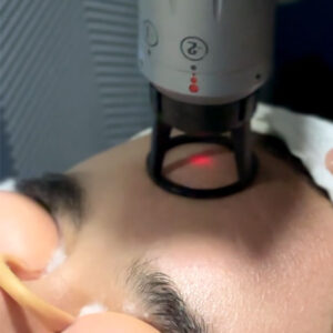 THE TONING LASER FACIAL